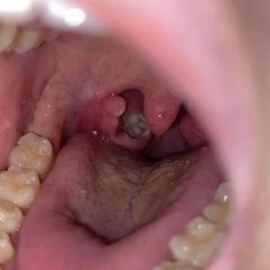 I sneezed 4-5 times yesterday and then felt something tickling my throat. Today, my throat is completely clear after this little thing came out. What is this? Well, you’d better know 610723245_1180027151012743_5122383939454908369_n